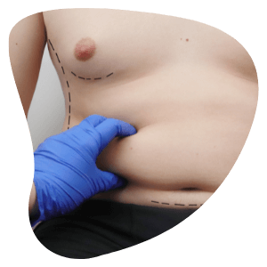 liposuccion pour hommes