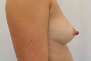 Avant augmentation mammaire