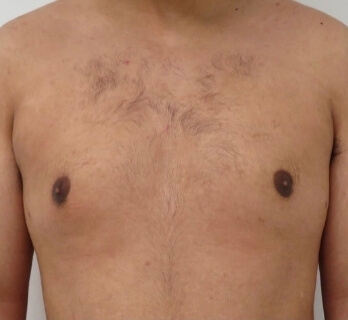 Gynecomastia