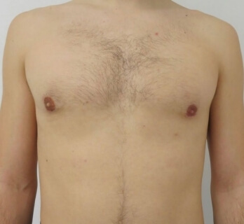 Gynecomastia man after