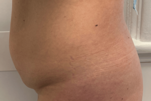 Avant abdominoplasties