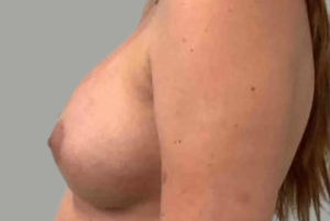 Après Augmentation Mammaire