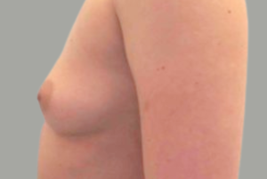 Avant Augmentation Mammaire