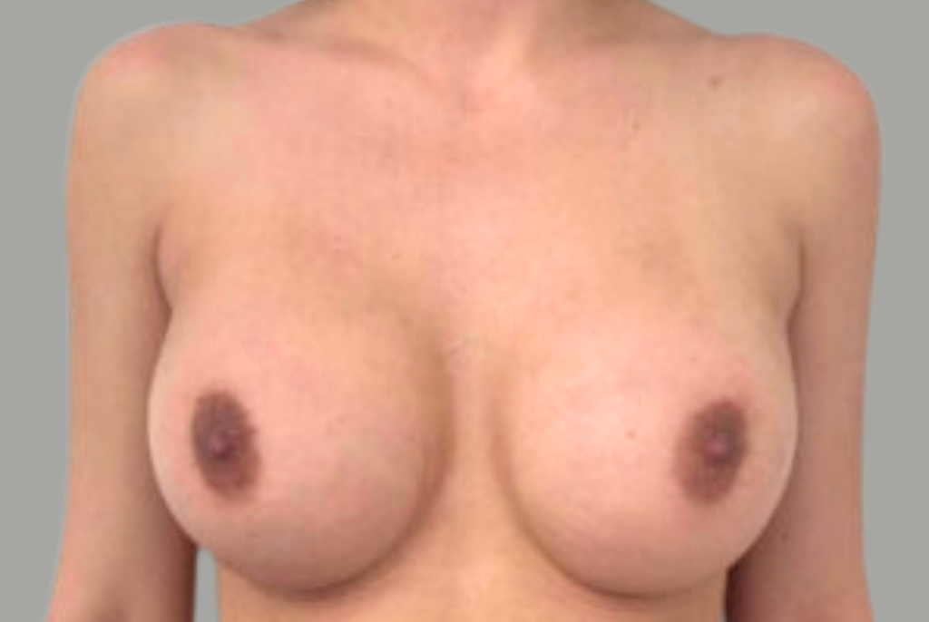 Photo avant après augmentation mammaire a montreal