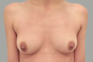 Avant Augmentation Mammaire