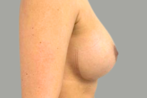 Augmentation mammaire silicone