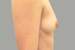 Avant Augmentation Mammaire