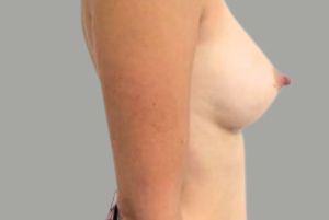 Augmentation mammaire silicone