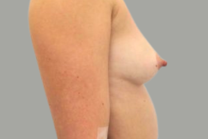 Avant augmentation mammaire