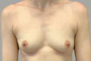 Avant Augmentation Mammaire