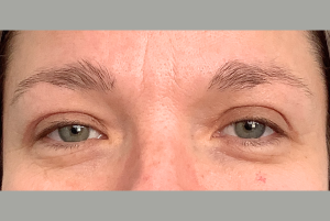 Après Blépharoplastie