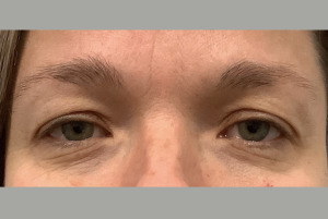 Avant Blépharoplastie