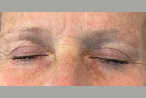 Après Blépharoplastie