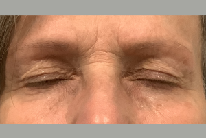 avant Blépharoplastie