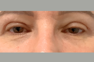 Après Blépharoplastie