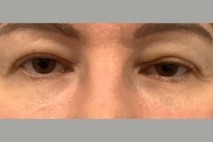 Avant Blépharoplastie