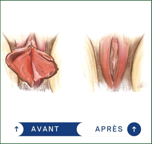 Resultat de labiaplastie a la Clinique Evolution