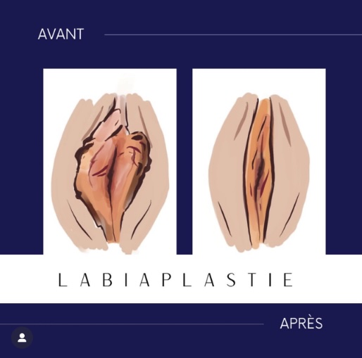 Resultat de labiaplastie a la Clinique Evolution