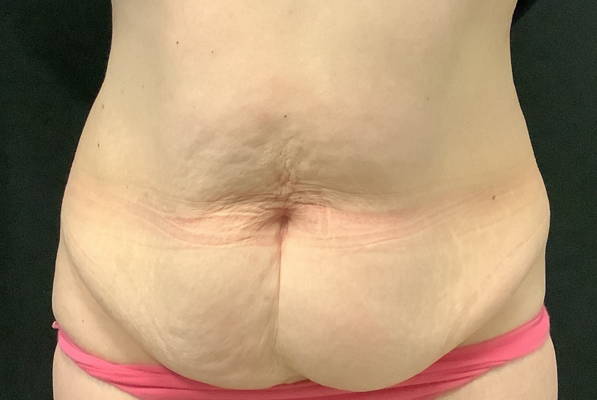 photo avant abdominoplastie, peau pendante