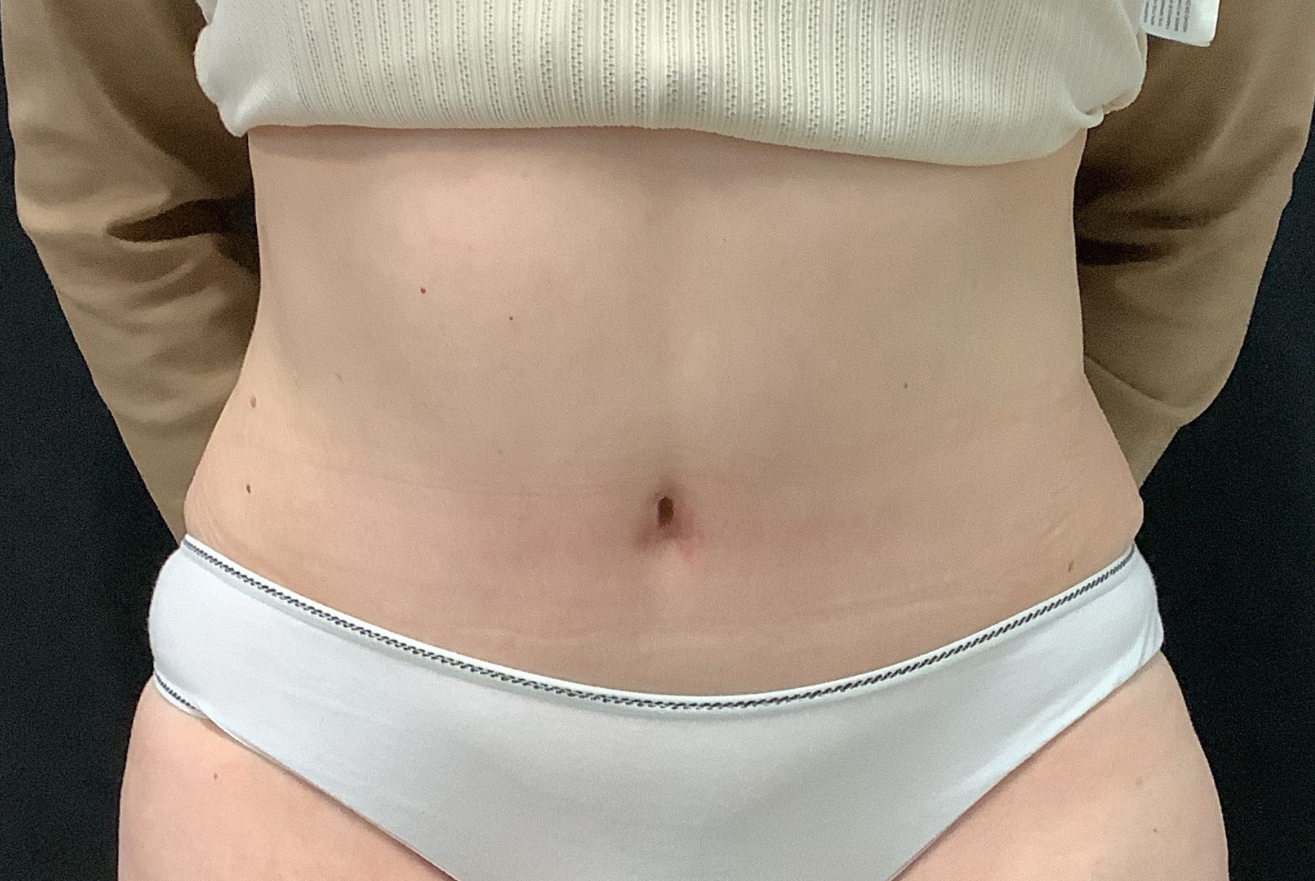 Photo Après Abdominoplastie
