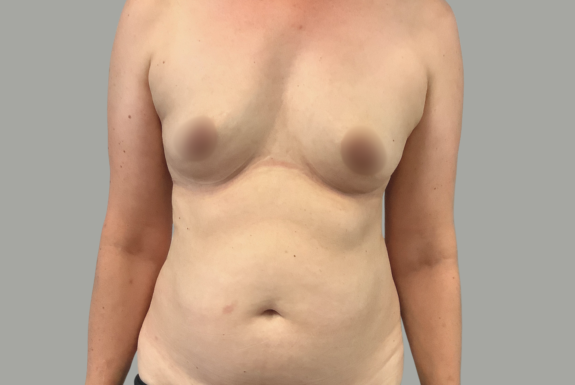 Avant Abdominoplastie / Mommy Makeover