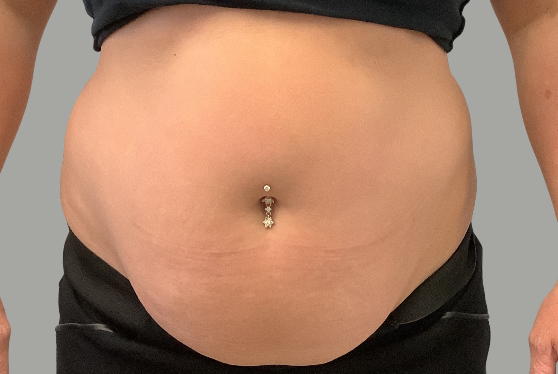 Avant Abdominoplastie