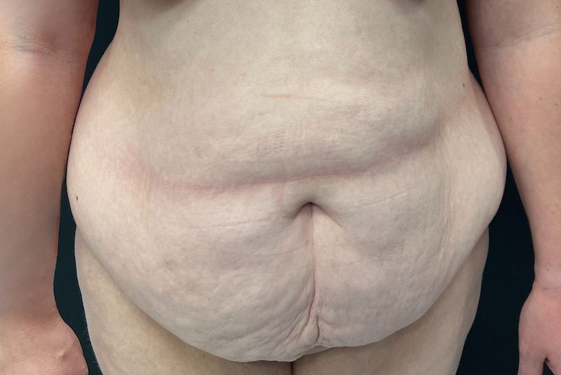 Photo ventre pendent avant Abdominoplastie