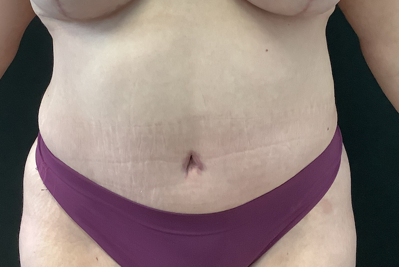 photo après chirurgie abdominoplastie clinique evolution