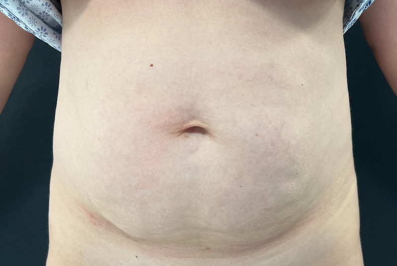 photo avanrt chirurgie abdominoplastie clinique evolution