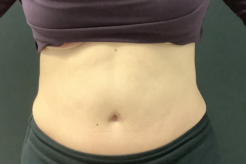 photo résultat après chirurgie abdominoplastie clinique evolution dr. Genevieve f-caron