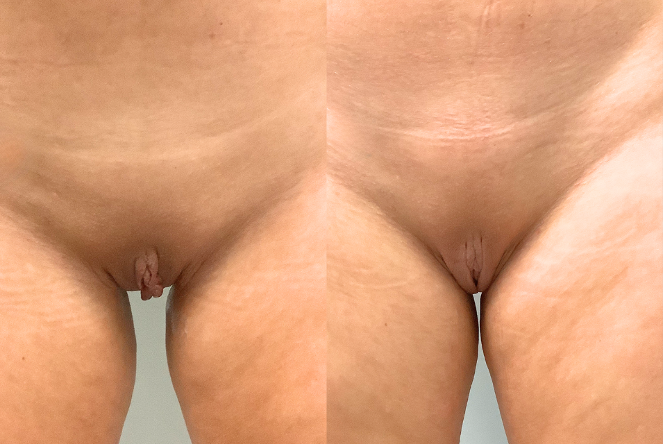 before after labiaplastie montreal clinique evolution