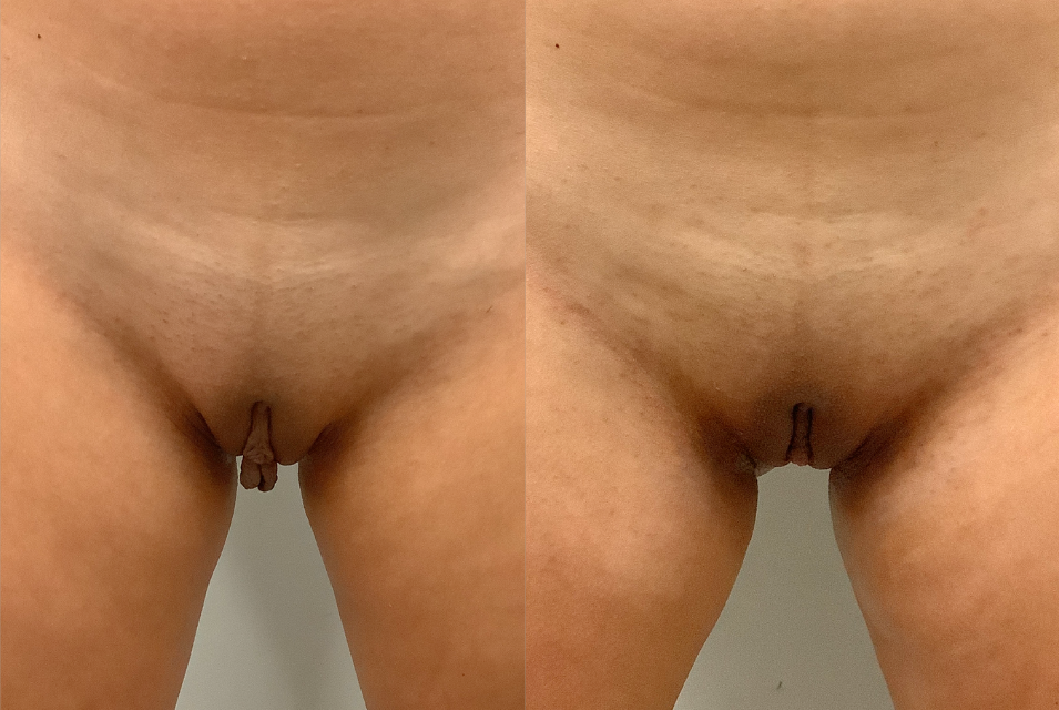 Photo avant après labiaplastie Montreal