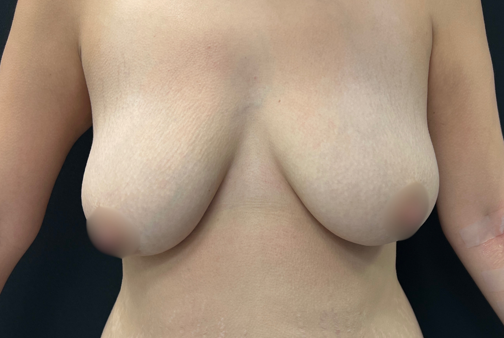 Photo avant chirurgie de redrappage/mastopexie