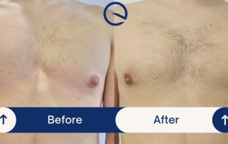 a Before and after example of a patient who underwent Gynecomastia correction surgery at Clinique Evolution Montreal