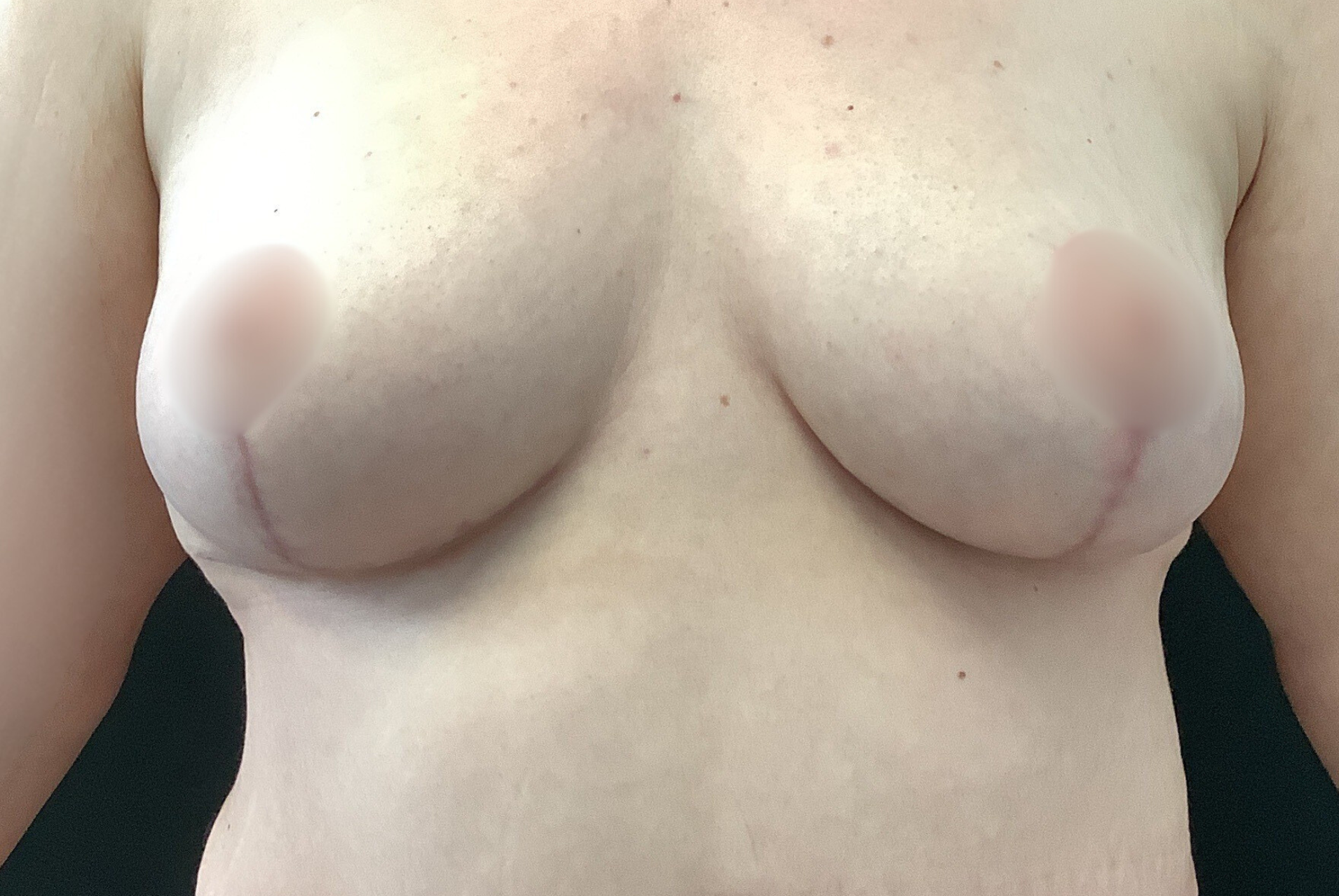 resultat et photo après chirurgie de redrapage