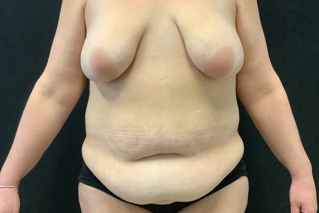 Avant Abdominoplastie
