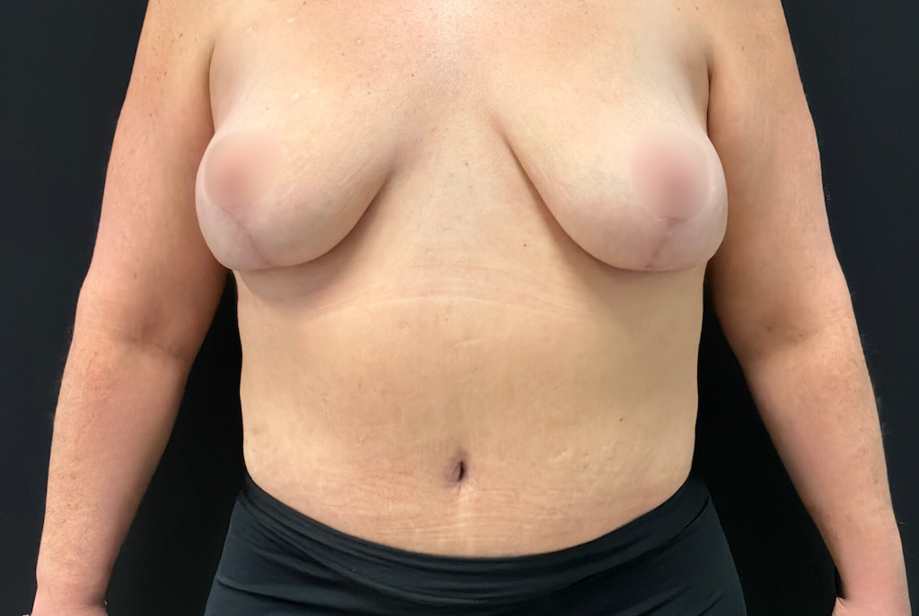 Après Abdominoplastie