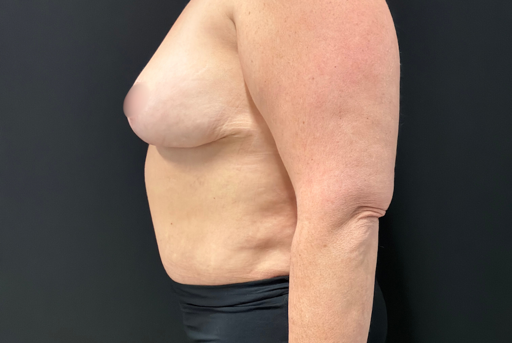Photo après une Abdominoplastie montreal