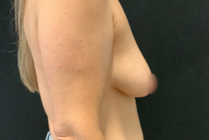 photo avant un redrappage mammaire a montreal
