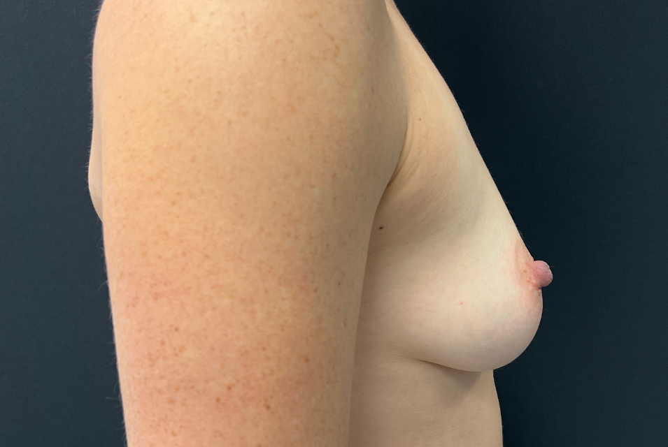 Avant Augmentation mammaire montreal3457.png