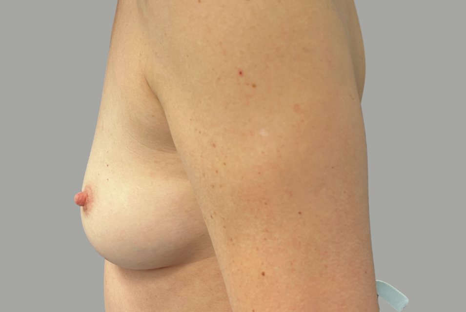 Avant Augmentation mammaire vue côté montreal3457.png